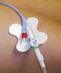 EA/1 CATH-SECURE MULTI-PURPOSE TUBE HOLDER 2 1/2IN WRAP TAB, BUTTERFLY BASE